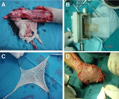 Skin grafting treatment of adolescent lower limb avulsion injury